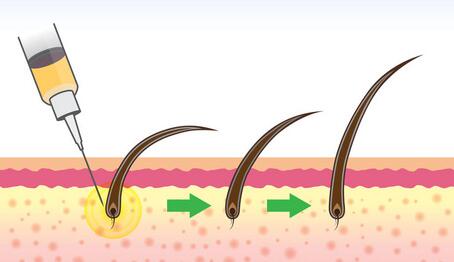植物养发馆：毛囊干细胞复活技术给雄脱带来希望！