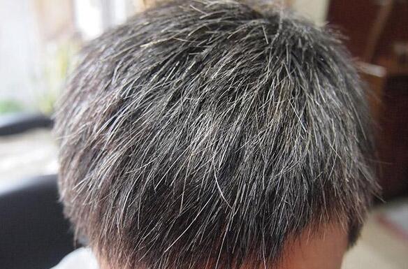 神草传奇养发专家告诉你：为什么要长白发，长白发的原因有哪些？